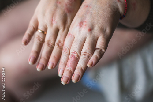 Psoriasis vulgaris on the womans hands with plaque, rash and patches on skin, isolated on white background. Autoimmune genetic disease. health concept