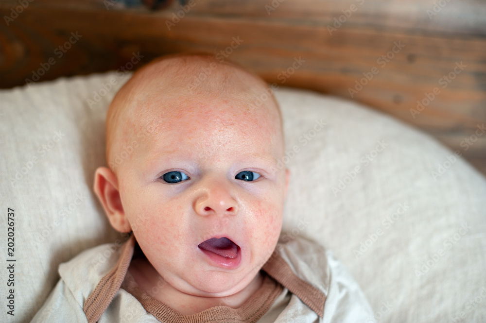 Allergies, atopic dermatitis on the face of a baby Allergies, atopic dermatitis on the face of a baby