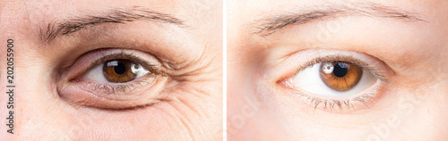 Fotografía Beauty care to reduce wrinkles and eye bags