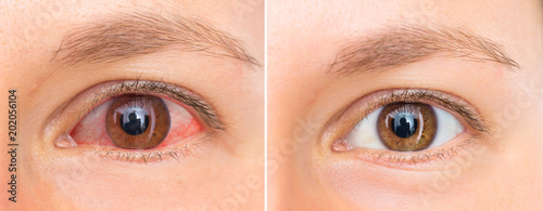 Red eye of woman before and after eyewash