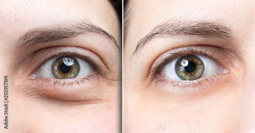 Swollen eye of woman before and after natural treatment to deflate them