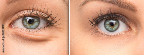 Woman eye bags before and after cosmetic treatment