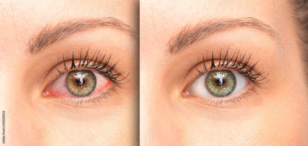 Fototapeta premium Woman eyes before and after eyewash, comparison with a red eye
