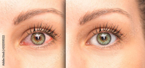 Woman eyes before and after eyewash, comparison with a red eye