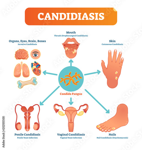 Candidiasis medical vector illustration diagram poster with all types of candida fungus on various human body parts and organs. photo