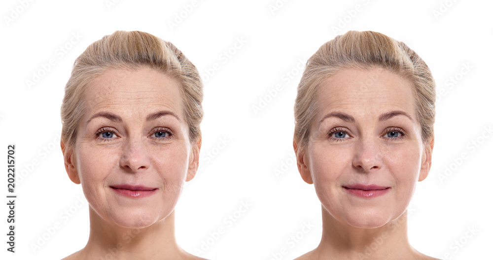 Middle aged oman face before and after cosmetic procedure. Plastic surgery concept. Middle aged oman face before and after cosmetic procedure. Plastic surgery concept.