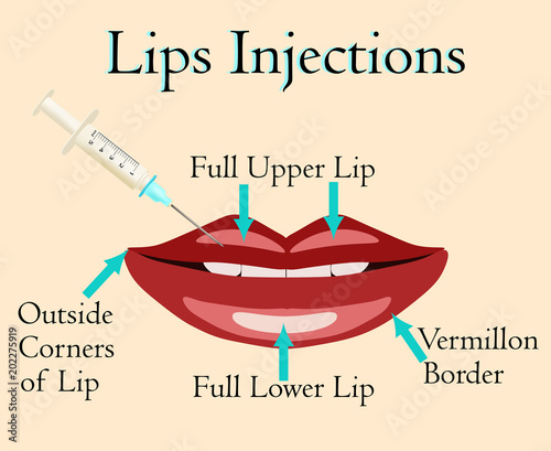 Lips injection vector illustration photo