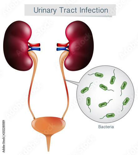 Urinary Tract Infection on White Background
