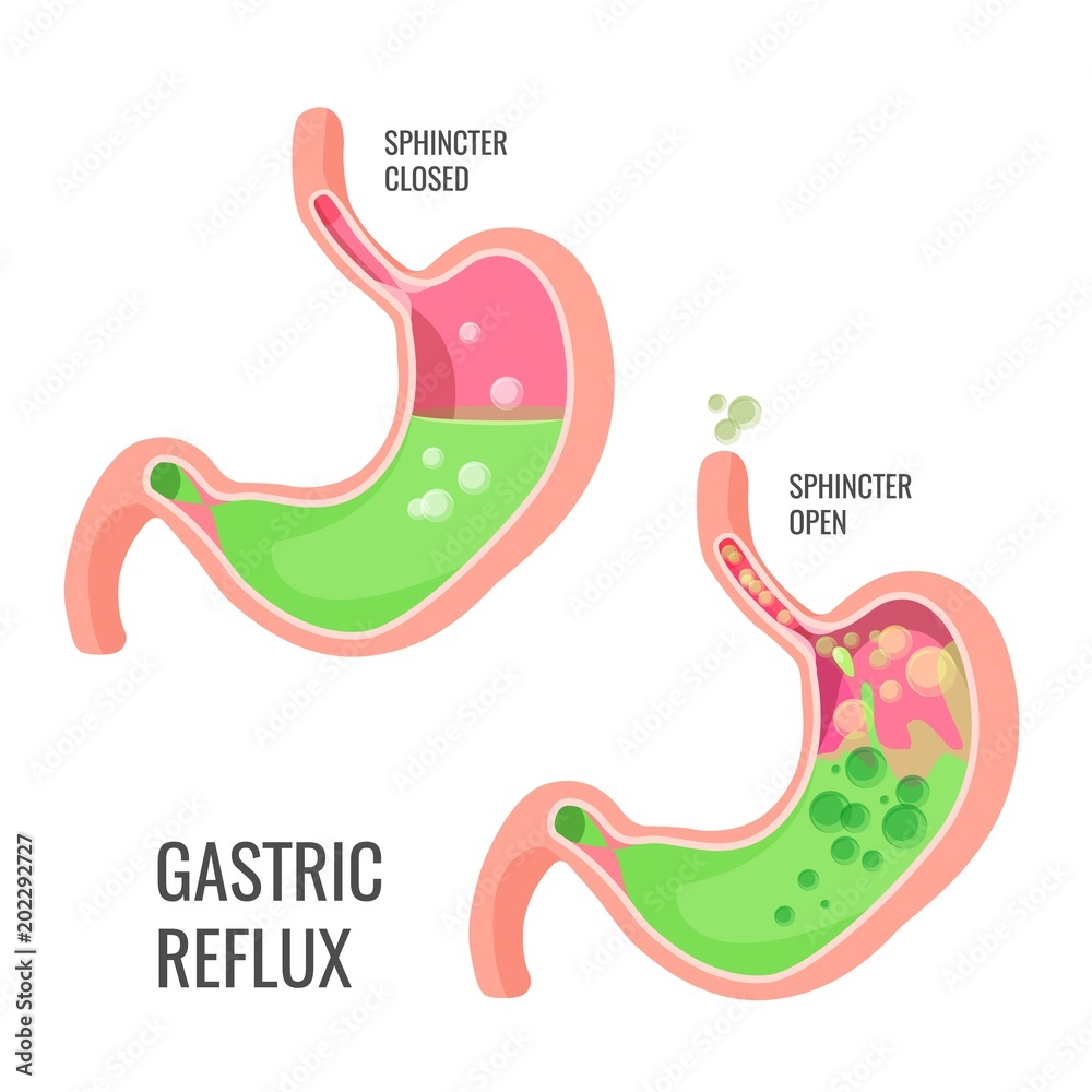 Gastric reflux medical promo poster with human organ Gastric reflux medical promo poster with human organ
