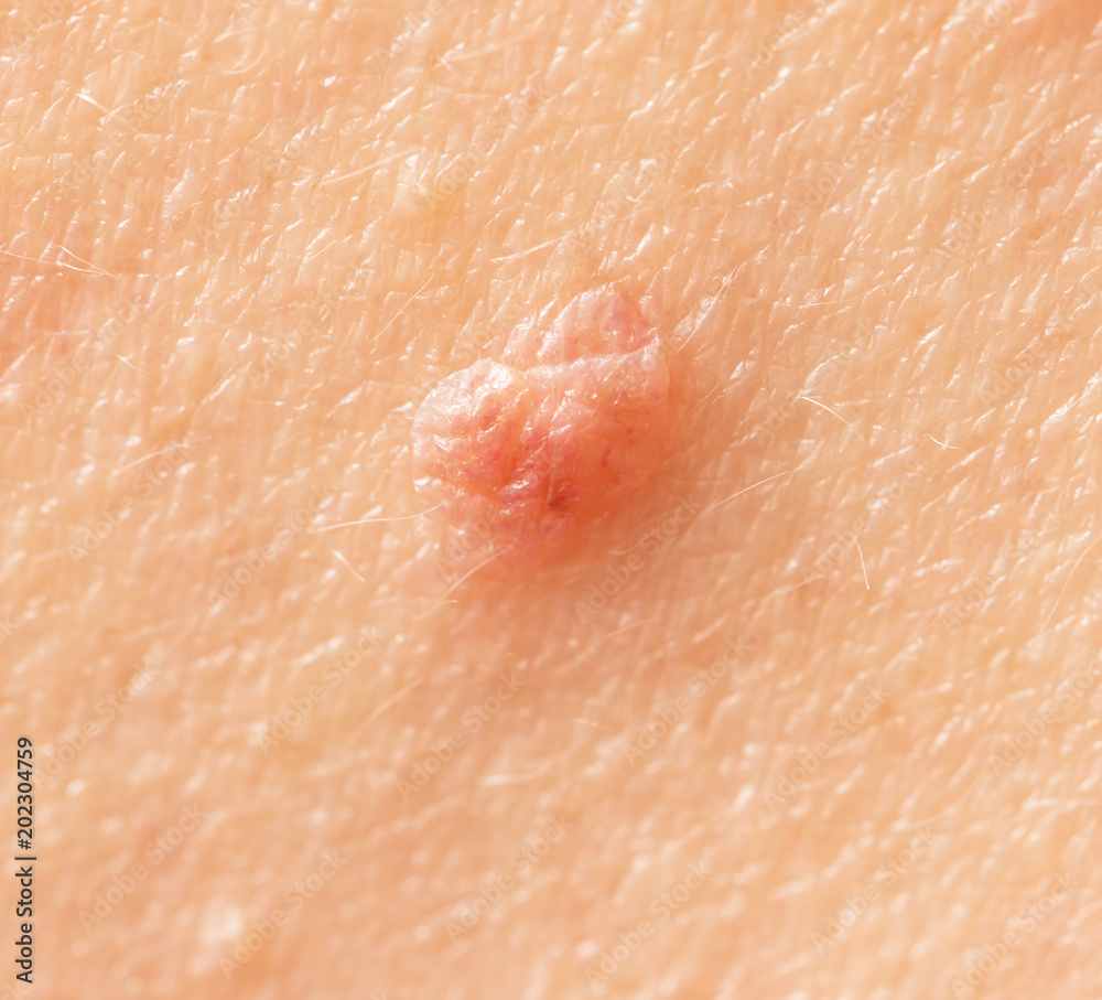 Fototapeta premium birthmark on skin