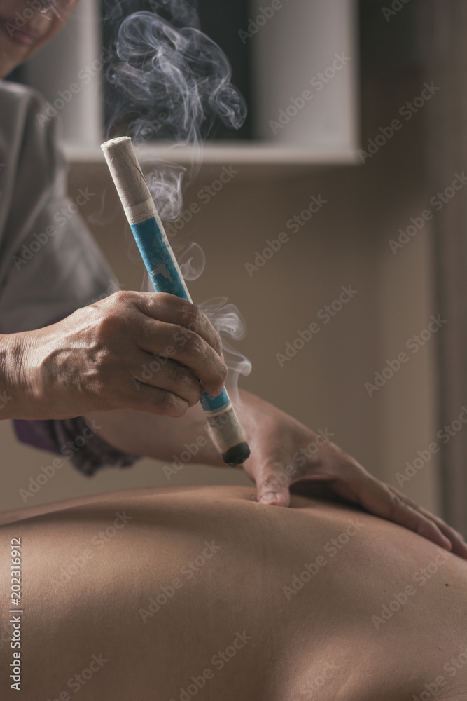 Therapist performing a moxibustion treatment. Therapist performing a moxibustion treatment.