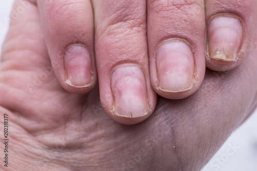 Onycholysis isolated on white background. Mechanical damage to the nail plate. Damage to the nail after applying shellac or gel-varnish (Gel-lacquer). © Sergey Privalov