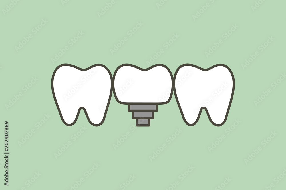 tooth implant, teeth change new root tooth implant, teeth change new root