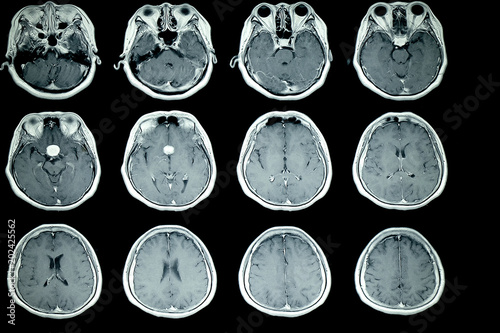 MRI scan of patient brain