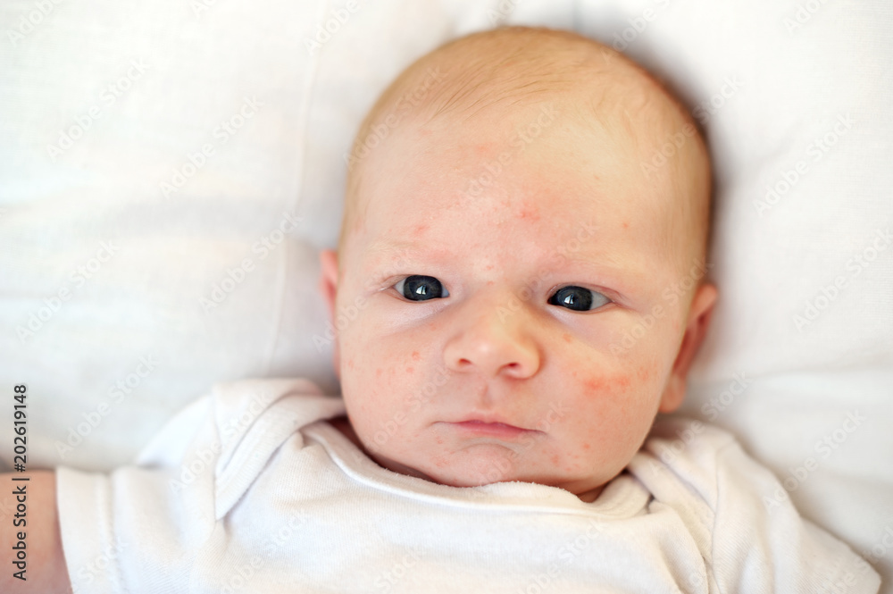 Allergies, atopic dermatitis on the face of a baby Allergies, atopic dermatitis on the face of a baby