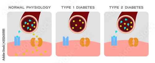 Insulin type / normal physiology , diabetes / unlocks the cell's glucose channel animation graphic