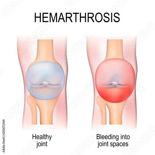 Hemarthrosis is a bleeding into joint spaces