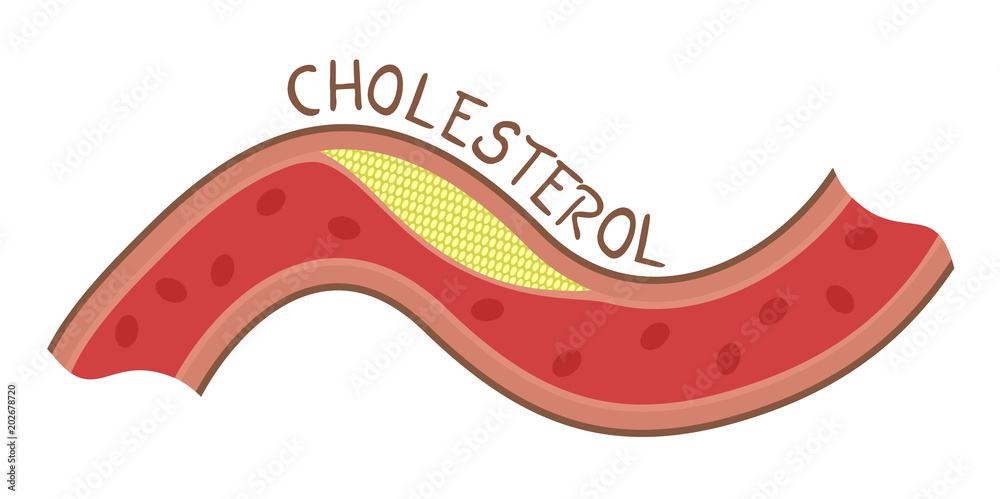 cholesterol illustration Stock Vector | Adobe Stock