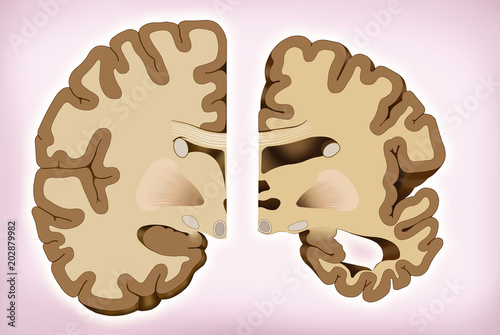 Ilustración descriptiva, muestra la comparación de dos mitades del cerebro, una mitad sana y otra con La enfermedad de Alzheimer photo