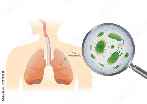 Finding virus in the human lung with a magnifier. Medical illustration about Viral Pneumonia.