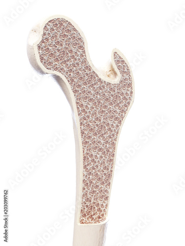 Obraz na plátne 3d rendered, medically accurate illustration of osteoporosis