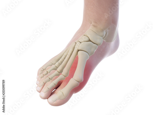 3d rendered, medically accurate illustration of a bunion