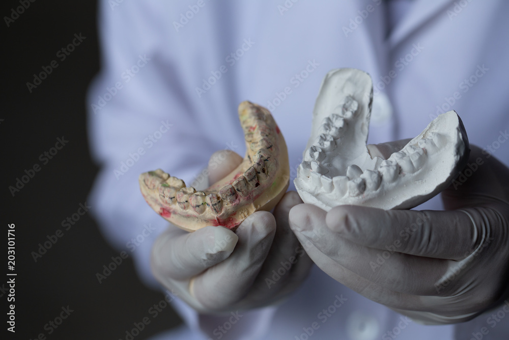 Study cast of Diagnostic cast and dental gypsum models in dental