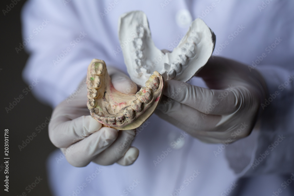 Study cast of Diagnostic cast and dental gypsum models in dental
