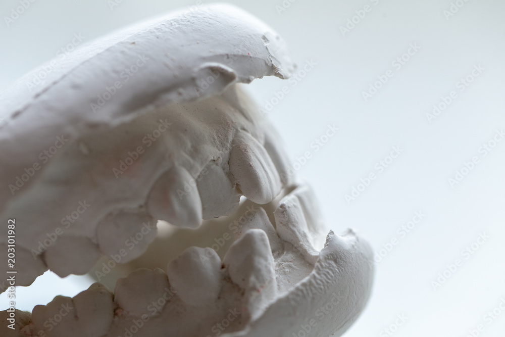 Study cast of Diagnostic cast and dental gypsum models in dental