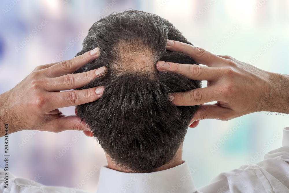 male showing head with circular thinning hair or alopecia Stock Photo |  Adobe Stock