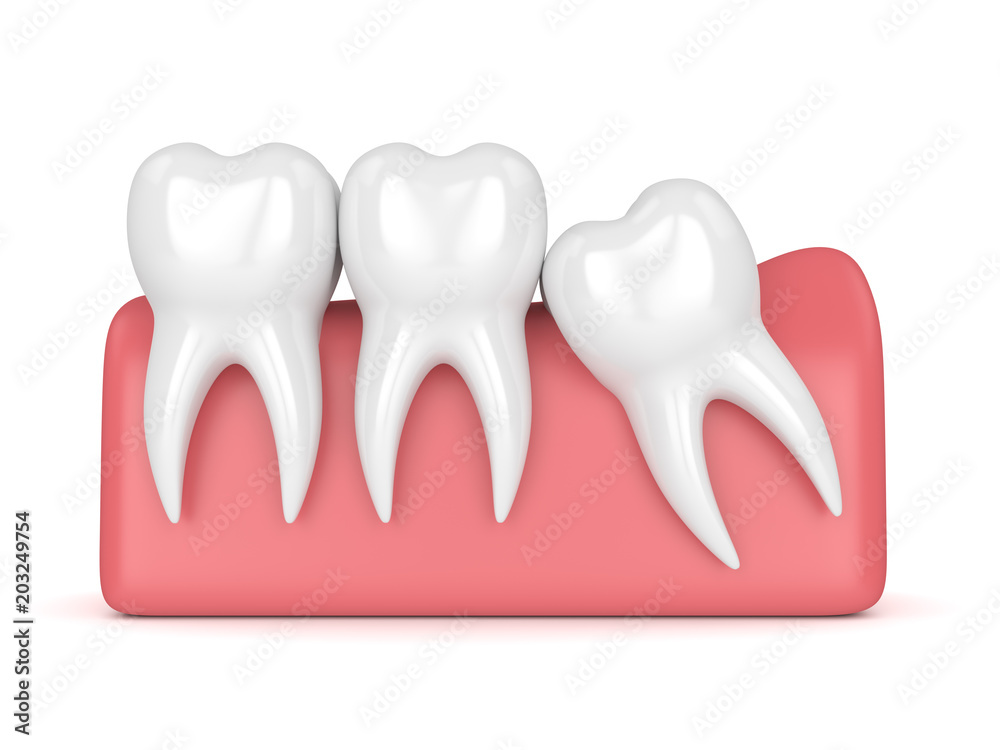 3d render of teeth with wisdom mesial impaction 3d render of teeth with wisdom mesial impaction