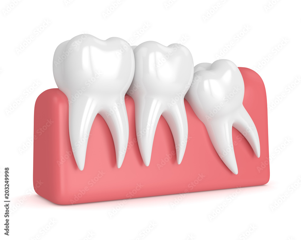 3d render of teeth with wisdom mesial impaction 3d render of teeth with wisdom mesial impaction