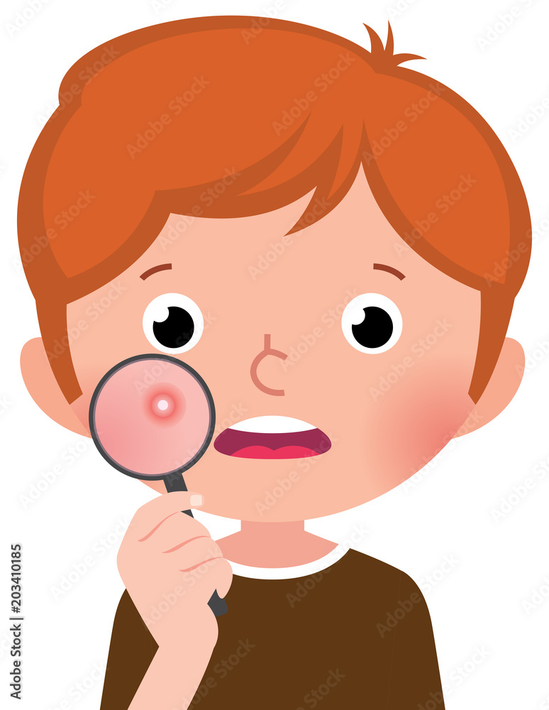 A teenage boy with a problematic skin examines a pimple through a magnifying glass A teenage boy with a problematic skin examines a pimple through a magnifying glass