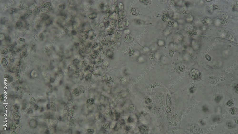 Stockvideon wet smear from vagina swab show epithelium cell , white