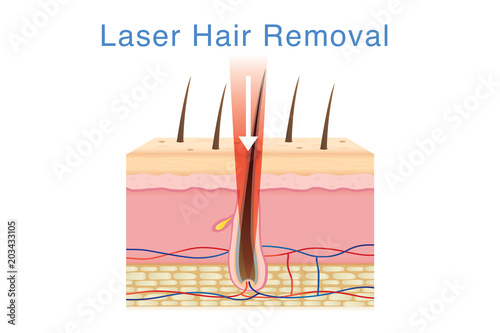 Laser light for hair removal on skin layer. Illustration about cosmetic technology.