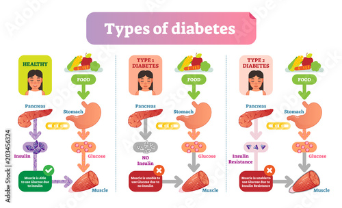 Types of Diabetes simple medical vector illustration scheme. Health care information diagram.