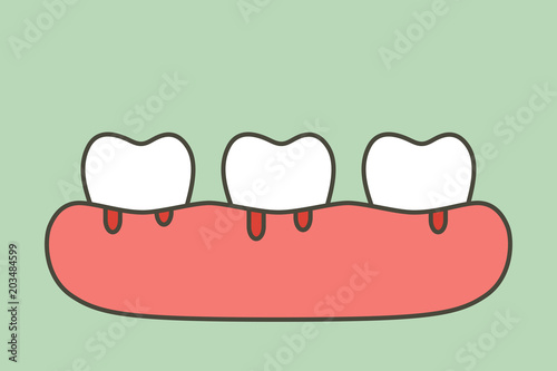 periodontitis or gum disease with bleeding ( blood flow come from gum and tooth ), dental problem