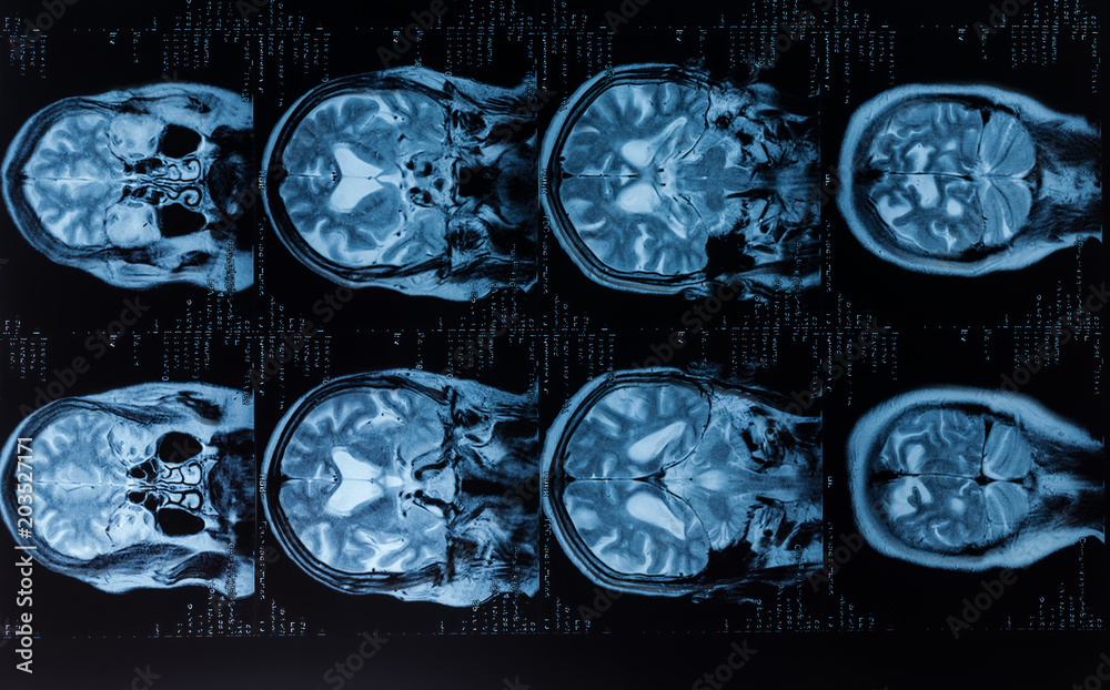 Head MRT. MR image of human brain Stock Photo | Adobe Stock