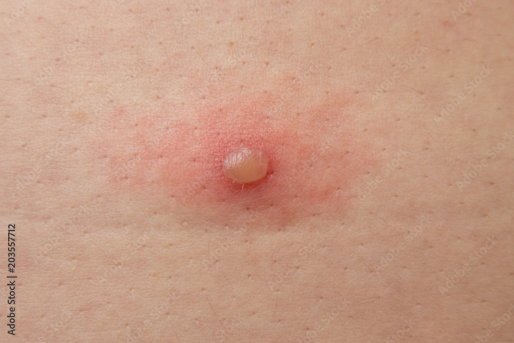 chickenpox or blister occurs on skin