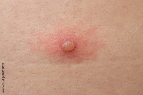 Obraz na plátně chickenpox or blister occurs on skin