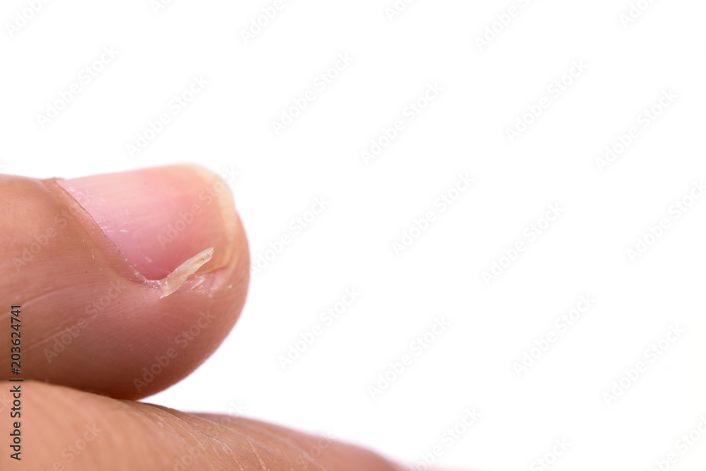 Fingers and nails shows Paronychial of nail on white background Fingers and nails shows Paronychial of nail on white background