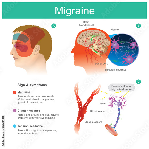 Migraine. Headache, pain, tend cooccur on one side of the head.Pressured blood vessels reduce blood flow for brain. Illustration. photo