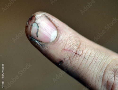 Wounded finger, closeup. Human finger