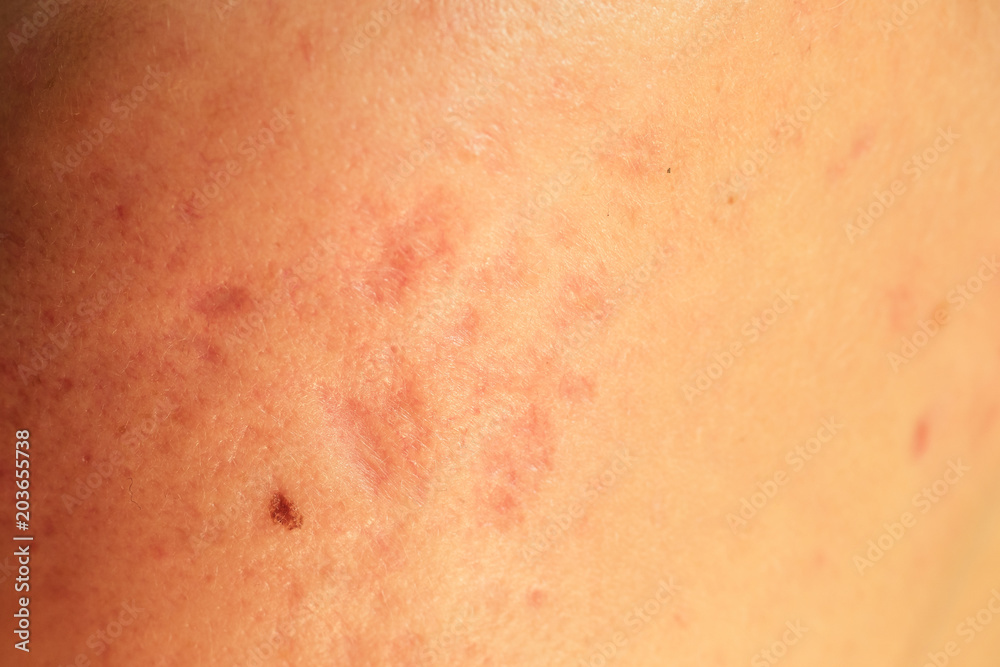 post-acne, scars and red festering pimples on the skin of the face. concept of skin problems and harmonic failure post-acne, scars and red festering pimples on the skin of the face. concept of skin problems and harmonic failure