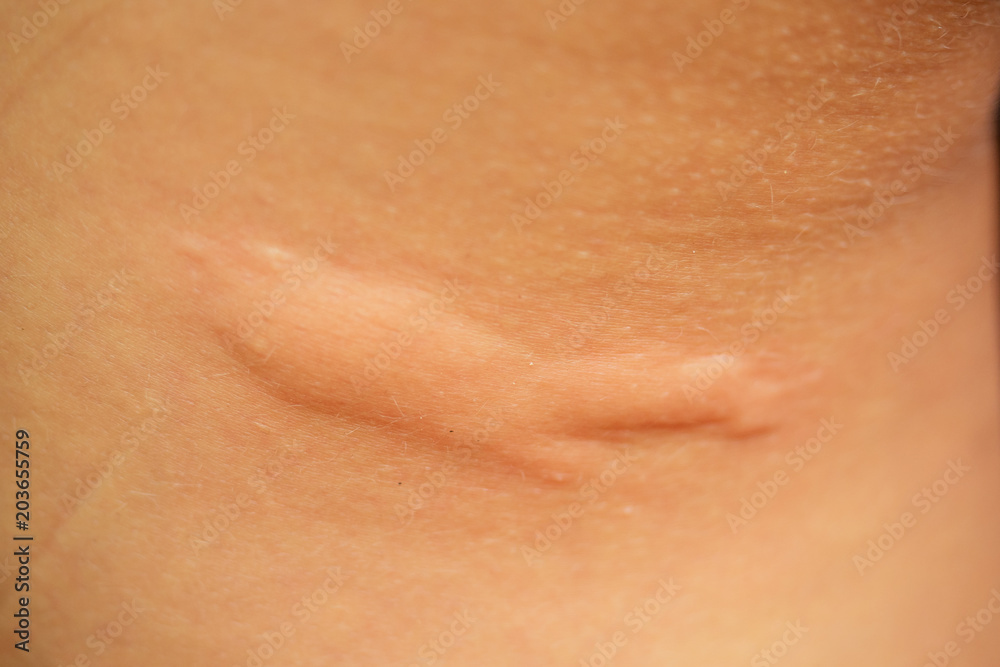 Fototapeta premium post-acne, scars and red festering pimples on the skin of the face. concept of skin problems and harmonic failure