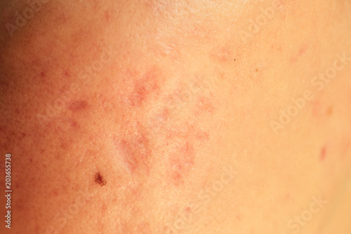 post-acne  scars and red festering pimples on the skin of the face. concept of skin problems and harmonic failure