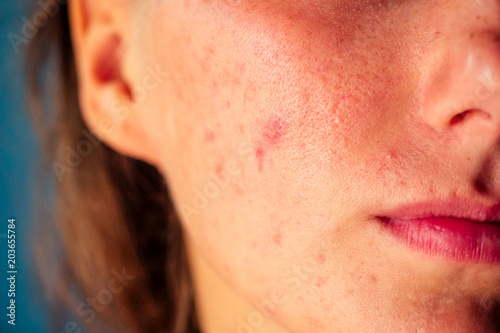 post-acne, scars and red festering pimples on the face of a young woman. concept of skin problems and harmonic failure photo