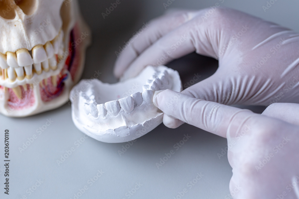 Study cast of Diagnostic cast and dental gypsum models in dental