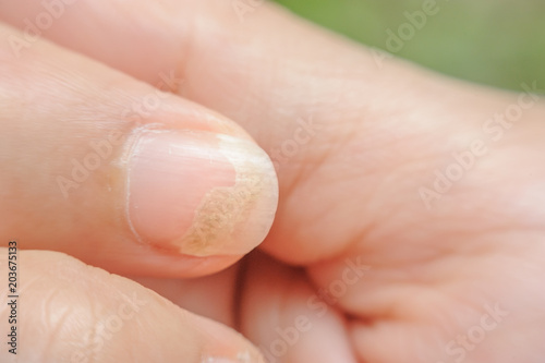 Onychomycosis or Fungal nail infection on thumb and forefinger, sickness concept