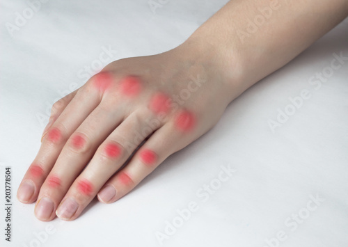 Hand of a girl on a white background whose joints on the arm hurt, red joints, white background